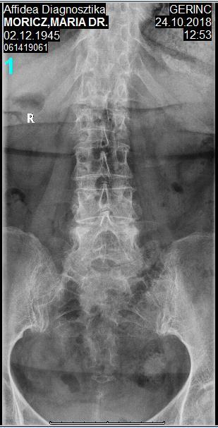 Spondylolisthesis L IV.