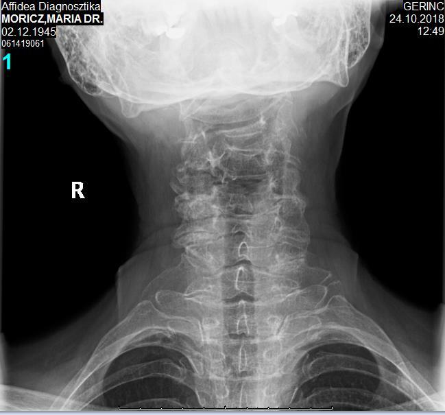 arthrosis