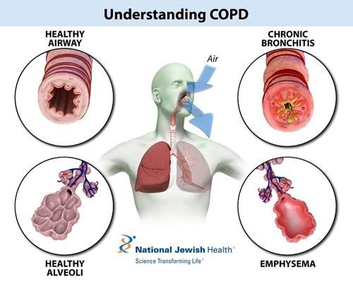 A COPD tünetei: Legveszélyesebb következménye a tüdőtágulásnak nevezett irreverzibilis tüdőkárosodás, sokáig nem okoz panaszt, először fizikai megerőltetésre