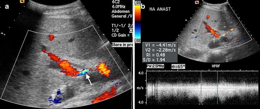 Vascularis szövődmények Arteria hepatica szűkület (14%) Turbulens, magas sebességű keringés a