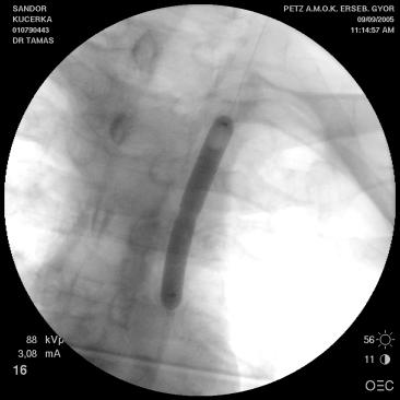 intracraniális intervenció (40/év) 2015-16 11