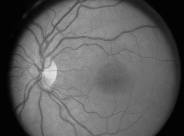 pdf Fénytörési hibák: astigmatizmus Fénytörési hibák: Szférikus és kromatikus aberráció Cornea