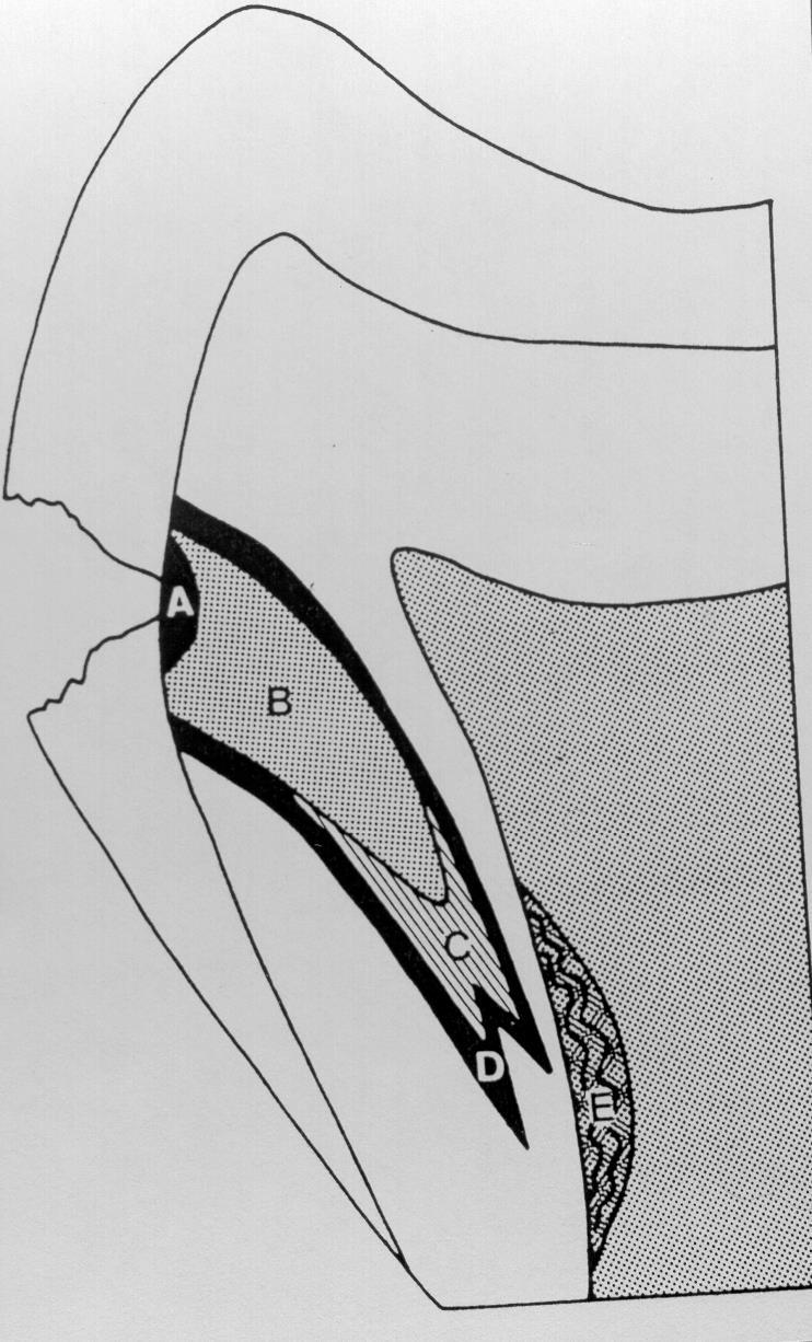 Morfológiai lokalizáció DENTINCARIES SZÖVETTANI RÉTEGEI RÉTEGEI Silverston 1981 Nekrozis rétege (üreg) Penetració rétege Demineralizáció