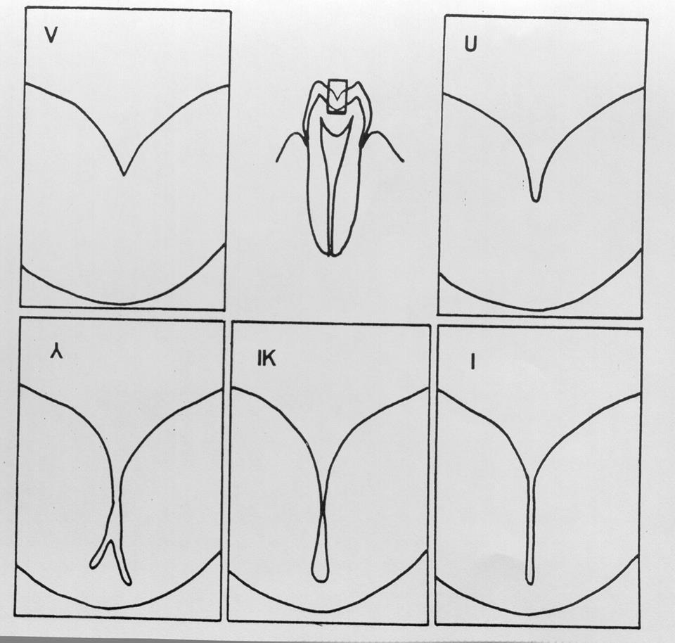 caries gyakoriság szempontjából?