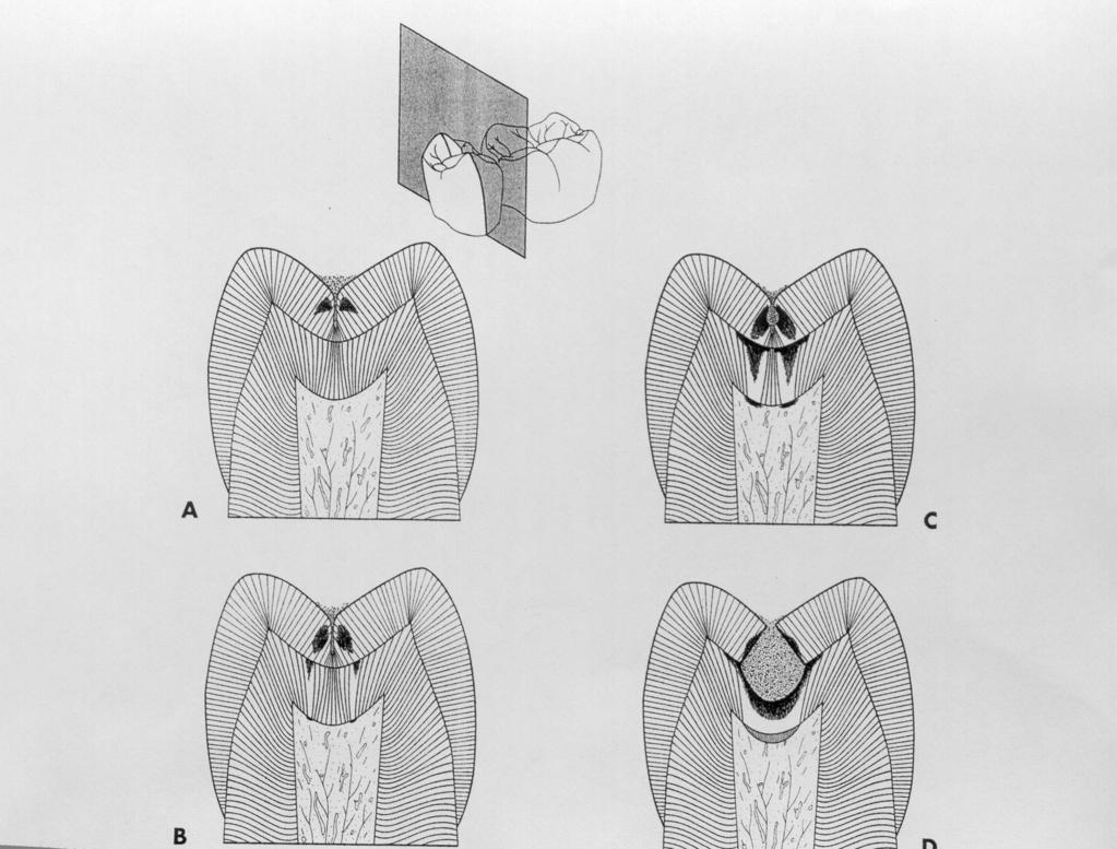 A caries terjedése a barázdákban (vestibulo-oralis metszet) 1.