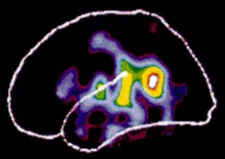 Az agyról egy szóbeli feladatsor megoldása közben készített pozitronemissziós tomográfiával felvételek