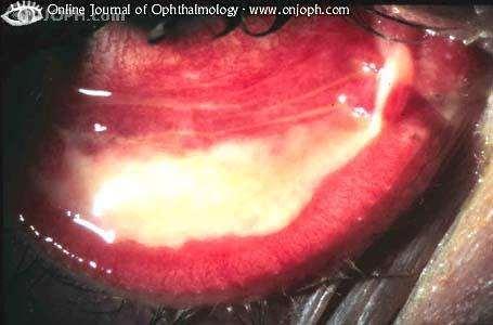 Conjunctivitis, pseudomembran, Streptococcus