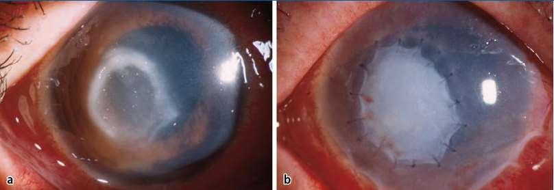 Amnion membrán transzplantáció Triple-graft-sandwich Seitz B, Resch MD, Schlötzer-Schrehardt U, Hofmann-Rummelt C, Sauer R, Kruse