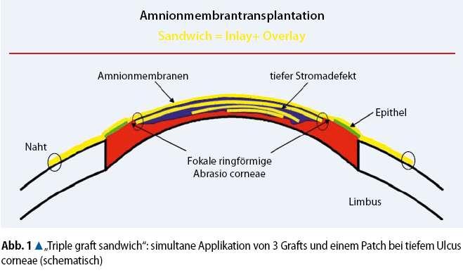 Amnionmembrán transzplantáció Seitz B, Resch MD, Schlötzer-Schrehardt U, Hofmann-Rummelt C, Sauer R, Kruse FE.
