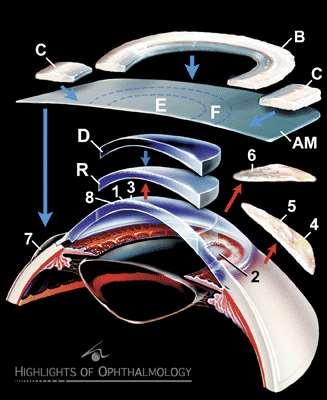 (1) cornea epitheliális és stromális defectus (2) cornea perforatio (3) cornea haze PRK után (4) conjunctiva reconstructio neoplasia excisio után (5) teljes szemfelszín reconstructio + limbalis