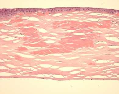 Hyalin - granularis