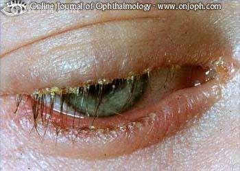 blepharitis