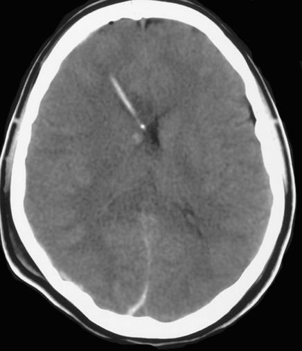 Diffúz agyoedema Az oldalkamrák