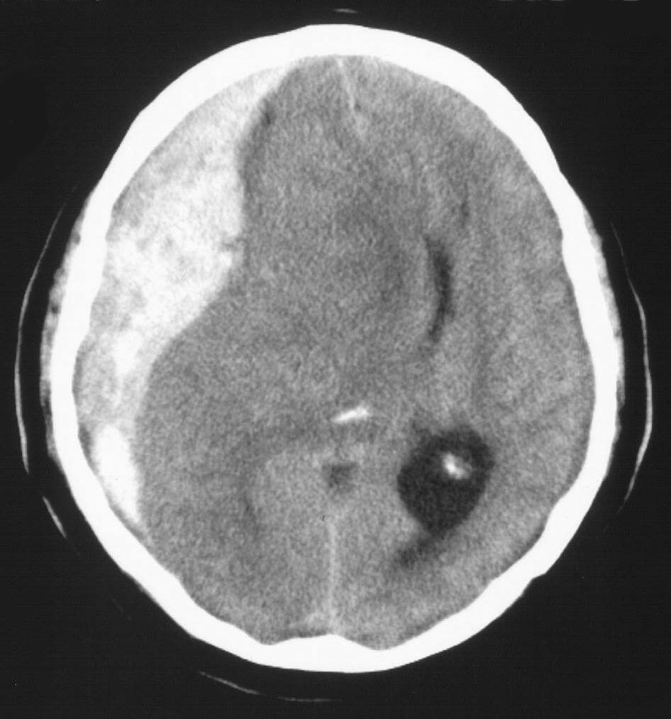 Subduralis haematoma Acut SH: az intracranialis nyomás gyorsan - sebészi kezelés nélkül halálos Chronicus SH: