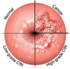 GENITÁLIS SZEMÖLCS, CERVICALIS DYSPLASIA, (CIN1,2,3) CARCINOMA