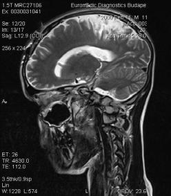 NÁ. 12 éves fiúgyermek 2011 NOV Busz baleset, polytraumatizációs: jobb