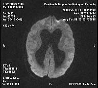 Bal facialis paresis+ liquorrhoea baloldalon DEC 2011 shunt előtt MR-1: gr-