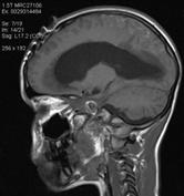 + Bilateralis periventricularis occipital lesions 2011 DEC progresszív HYDROCEPHALUS