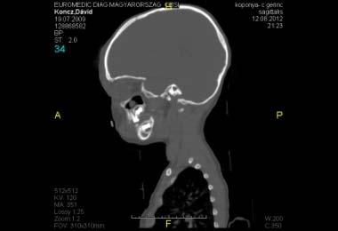 KÁ. 3 éves fiúgyerek AUG 12-2012 8 méter magasról lezuhant, impressziós koponyatörés (fronto-parieto-temporalisan)