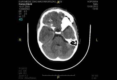 kompenzált agyi keringés +mérsékelt liquorcsorgás az orrnyílásokon de HIP jelei nélkül - obszerváció MR-1 : AUG-12 2012 AUG-22