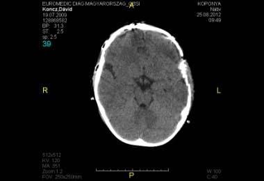 Craniotomia (bifrontalis behatolással): frontobasalis csont rekonstrukció + orbita tető dekompressziója+ dura plasztika