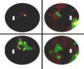 EGY vagy KÉTOLDALI LÁTÁSVESZTÉS - kivizsgálás folyamata - 2 antechiasmalis- chiasma retrochiasmalis látóideg szakasz Látásélesség (T, K)= MONOCULARIS NEURITIS macula betegség Eo.