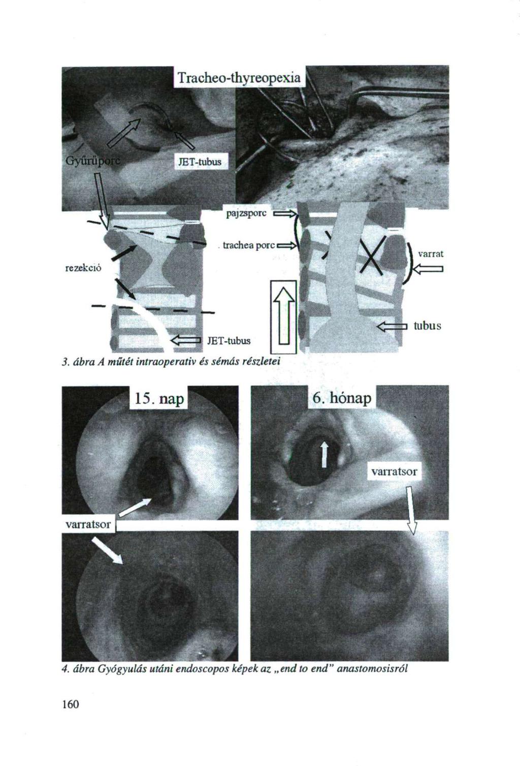 Tracheo-thyreopexia JET-tubus paj zsporc varrat tubus JET-tubus 3.