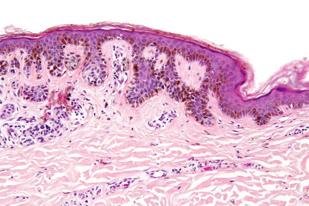 Dysplasticus naevus Viselkedésük benignus, de makroszkóposan malignitás gyanúját vethetik fel. Nagyobbak, mint a szerzett naevusok (>5mm), szabálytalan a körvonaluk.