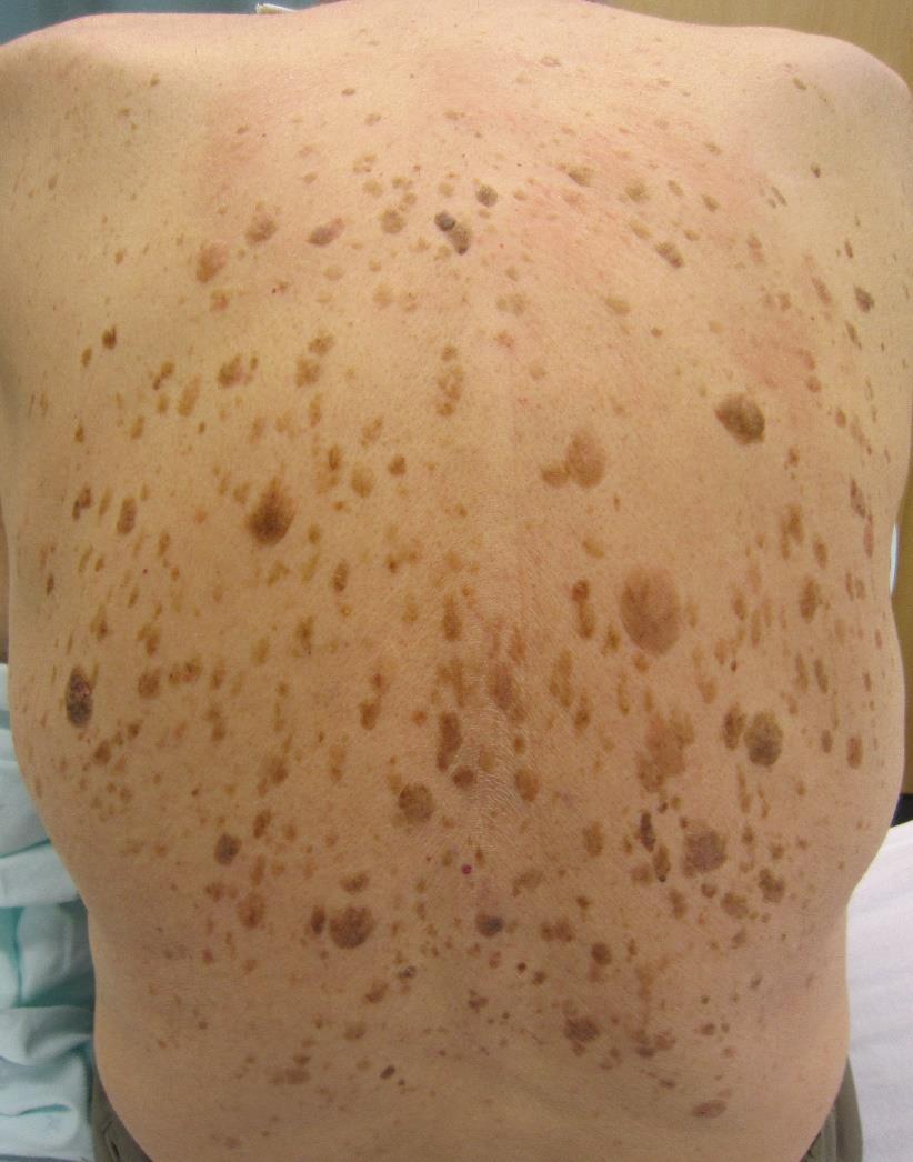 Seborrheás keratosis Jóindulatú, epidermális daganat.