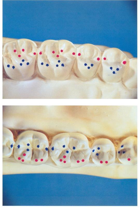 Az alsó és felső fogív összezárásakor a hiánytalan fogazat, vagy a sok helyen érintkező fogpár esetében, megszokott a fogsorzáródás, az állkapocs helyzet ugyanabban a helyzetben van, ezért ezt