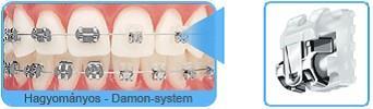 Új, klinikailag kipróbált kezelési módszer, amellyel a fogak kíméletesebben szabályozhatóak 4.