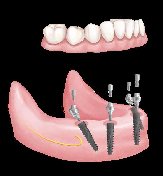 Alkalmazás 17 All-on-4 és All-on-6 előnyös megoldások All-on-4 a gazdaságos megoldás Az All-on-4 megoldással nagy stabilitás érhető el, mindössze négy implantátum beültetésével.