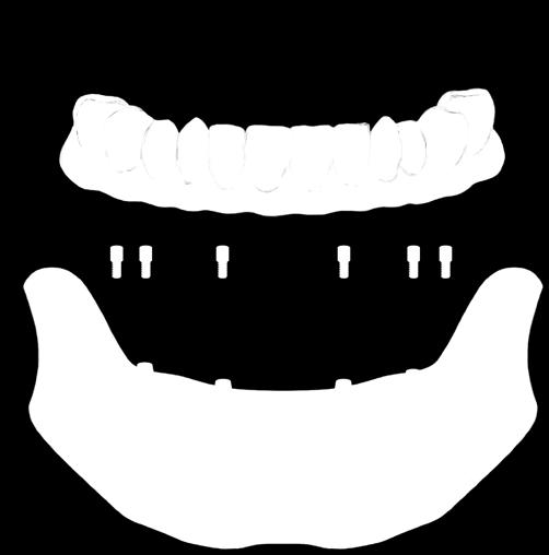 All-on-4 megoldás A kezelési idők rövidebbek és a költségek alacsonyabbak lehetnek a hagyományos implantátumkezelési módokhoz képest.