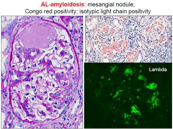 Renalis amyloidosis