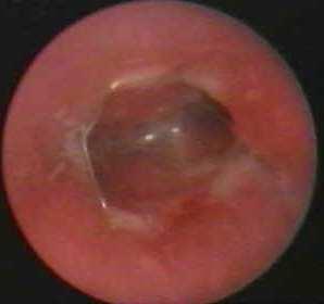 coronaria stent 17 hó stent eltávolítás - sarjszövet 80% bal