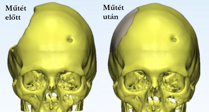 Biomechanica Hungarica XI. évfolyam, 1. szám plantátum geometriájának további módosításait javasolhatja.