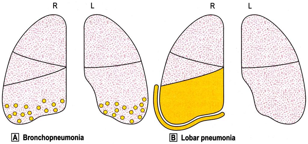 Bronchopneumonia Lobaris pneumonia JCE