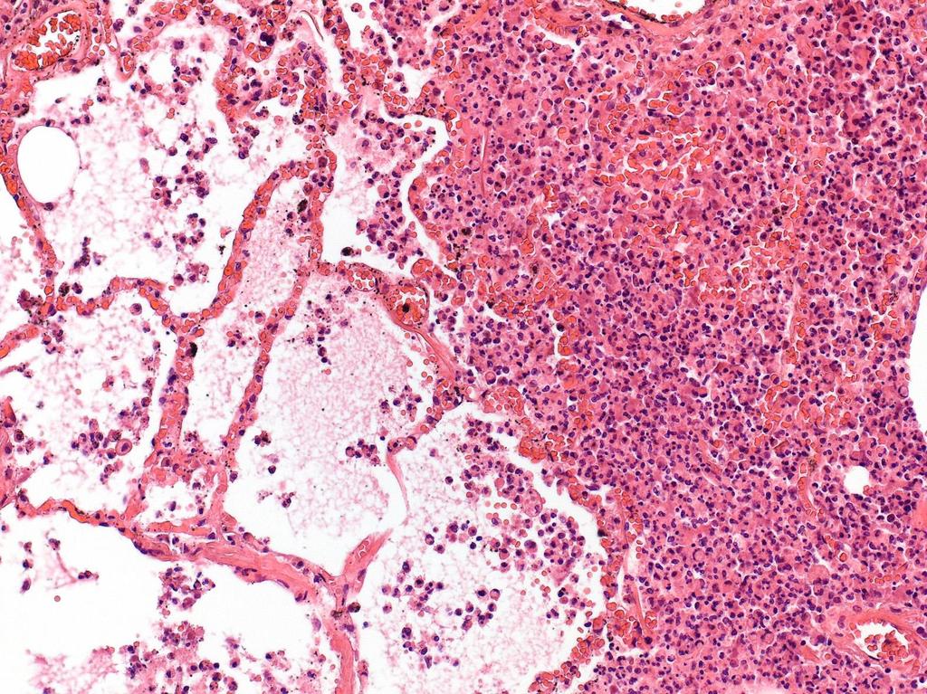 Bronchopneumonia: neutrophil granulocytákban