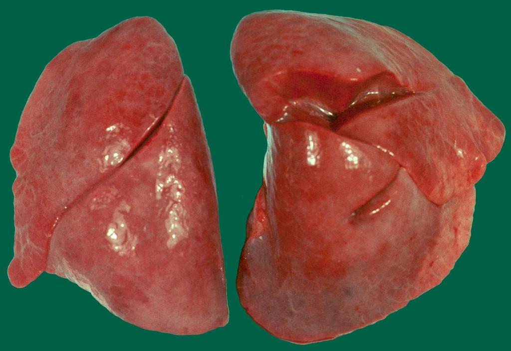 RS virus pneumonia