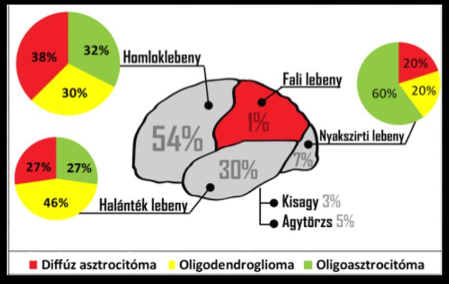 A magas grádusú gliális daganatok 85%-a (182 eset) WHO IV. grádusú glioblasztóma, míg a maradék 15% (32 eset) III. grádusú anaplasztikus gliális tumor volt.