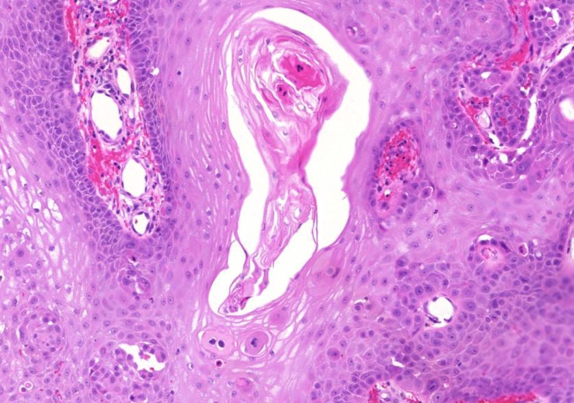 Laphám carcinoma