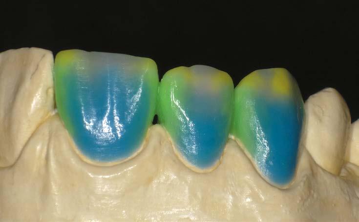 18. Dental World Budapest 15 Az amalgám még sokáig visszajár Uniós rendelkezés szerint már júliustól tilos amalgámmal tömni a terhesek és a 15 éven aluliak lyukas fogait.