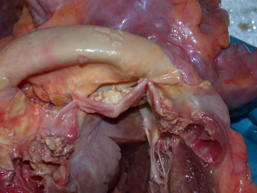 Az aorta billentyű roncsoló, fertőzéses subacut endocarditise paravalvularis abscessussal.
