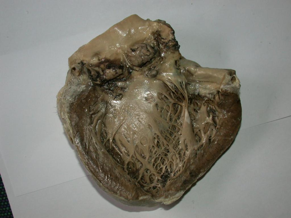 Az aorta billentyű ulcerosus endocarditise a billentyű súlyos roncsolódásával, billentyű elégtelenséggel és