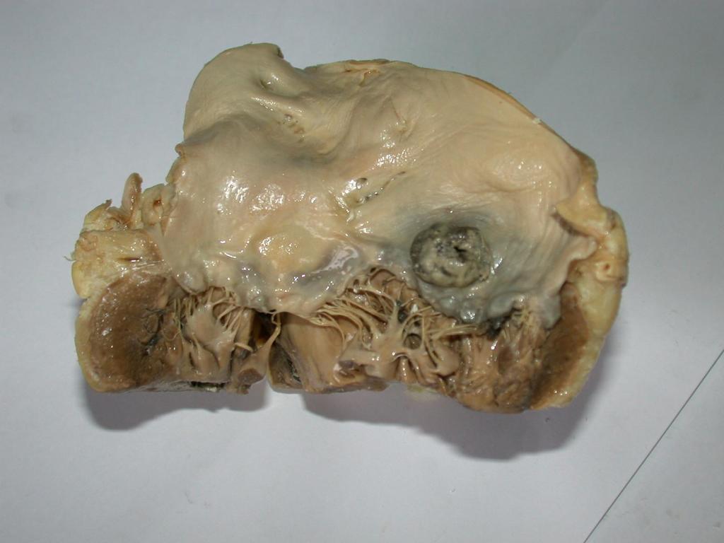 A mitralis billentyű ulcerosus, perforáló endocarditise A Pathologiai