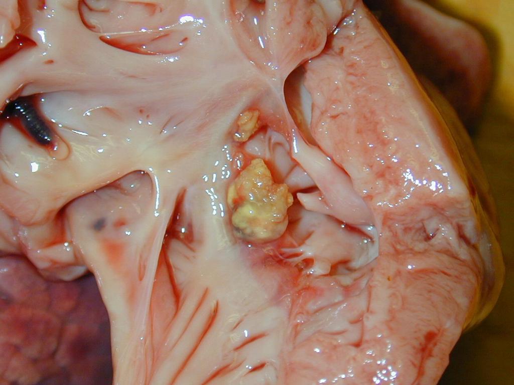 Gócos fali endocarditis Kórboncolási