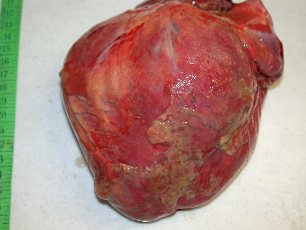 Rostonyás szívburokgyulladás Kórboncolási