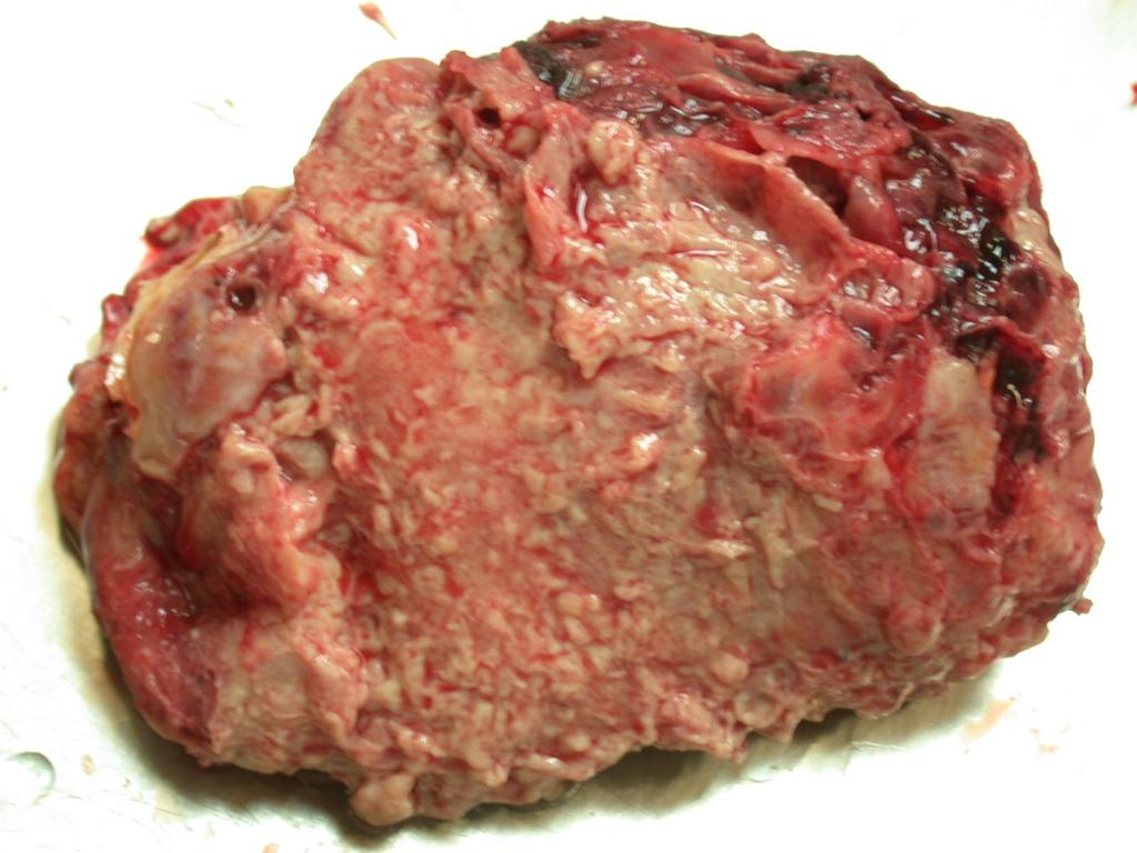 Félheveny gennyes szívburokgyulladás: a szívburokzsák tömeges rostonyás-gennyes izzadmánnyal telt (empyema pericardii).