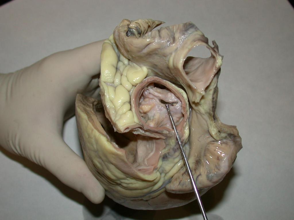Degenerativ aorta vitium (stenosis) kivételesen súlyos esete, amelyben az aorta eredeti lumenének csupán egy néhány