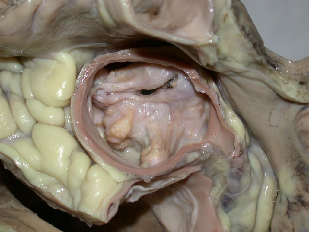 Degenerativ aorta vitium (stenosis) kivételesen súlyos esete, amelyben az aorta eredeti lumenének csupán egy néhány